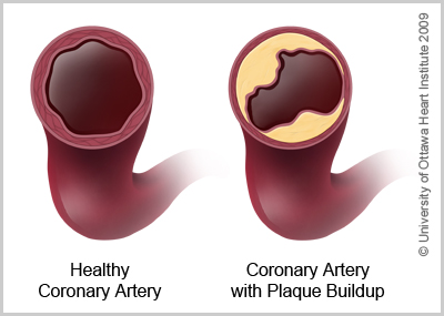 Illustration showing difference between healthy artery and a coronary artery with plaque buildup