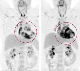 The presence of cardiac sarcoidosis is indicated in this full-body PET scan (left) by the dark regions in the heart. The male patient in his mid-40s, seen at the University of Ottawa Heart Institute’s Cardiac Sarcoidosis Clinic, received an implantable cardioverter defibrillator to manage the arrhythmia caused by his condition, but he declined steroid therapy due to concerns about side effects. Eight months later, a follow-up scan (right) showed the significant spread of CS in the muscle tissue of his heart.