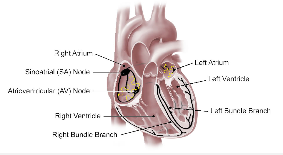 Medical illustration showing the atria, nodes and ventricles of the heart, through which electrical impulses fire irregularly or too quickly in atrial fibrillation.
