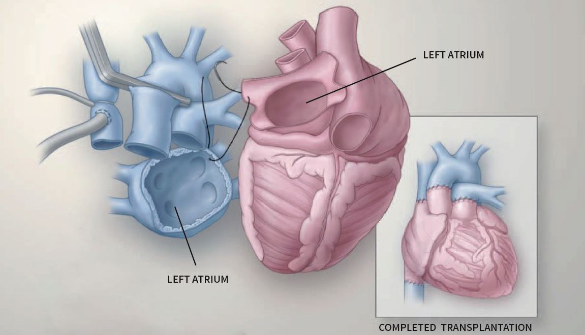 Medical illustration showing the connection of the patient and donor heart atria in a bicaval heart transplant procedure.