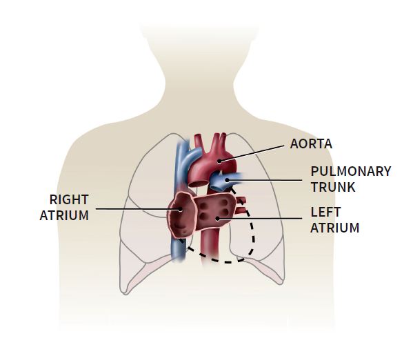 Medical illustration showing the right atrium, aorta, pulmonary trunk and left atrium after the patient heart is removed during a heart transplant procedure.