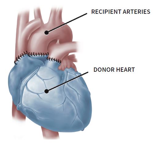 Medical illustration showing the recipient arteries and donor heart after being connected in a heart transplant procedure.