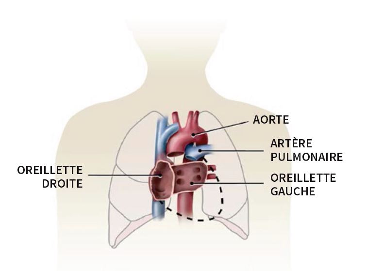 Illustration médicale montrant l'oreillette droite et gauche, l'aorte, et l'artère pulmonaire après que le coeur du patient est enlevé pendant la transplantation.
