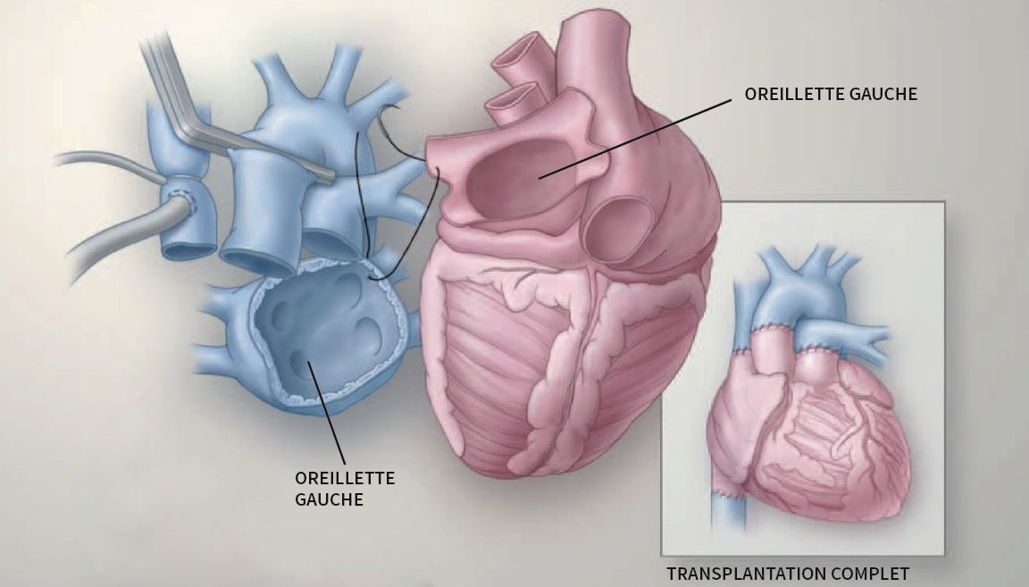 Illustration médicale montrant la connexion entre les oreillettes du patient et le coeur du donneur avec la technique bicavale.
