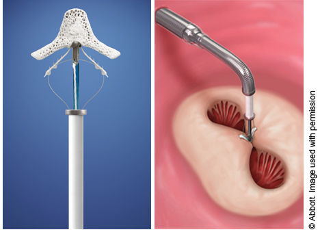Image of the Mitraclip device and how it clips to the mitral valve