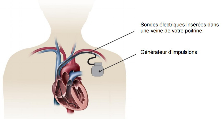 Illustration d'un coeur et d'un dispositif de resyncronisation cardiaque montrant le générateur d'impulsions et les fils électriques insérés dans le coeur.