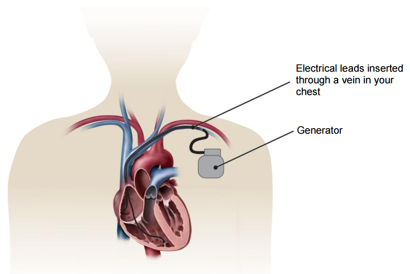Illustration of a heart and an Implantable Cardioverter Defibrillator (ICD), showing the ICD generator and the electrical leads inserted into the heart.