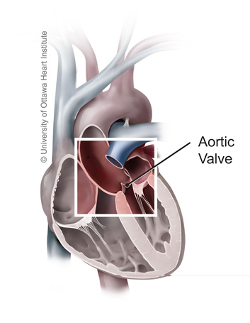 Medical illustration of a heart highlighting the aortic valve which is narrowed or cannot open properly in aortic stenosis.