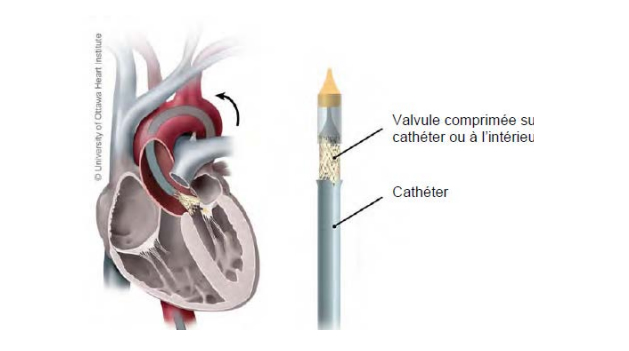 Illustration montrant un cathéter et une valvule, d'une part, et d'une autre, une coupe transversale du coeur montrant la voie qu'emprunte le cathéter lors de la procédure.
