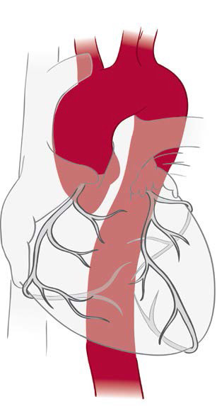 Medical illustration of the heart highlighting the aorta.