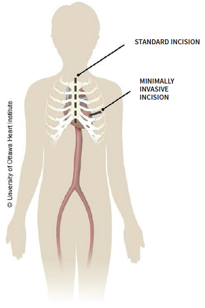 Medical illustration of a heart and ribcage showing the incision sites for standard and minimally invasive coronary bypass surgeries.