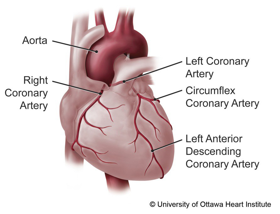 Medical illustration of a heart showing the aorta, right coronary artery, left main coronary artery, circumflex coronary artery and left anterior descending coronary artery.