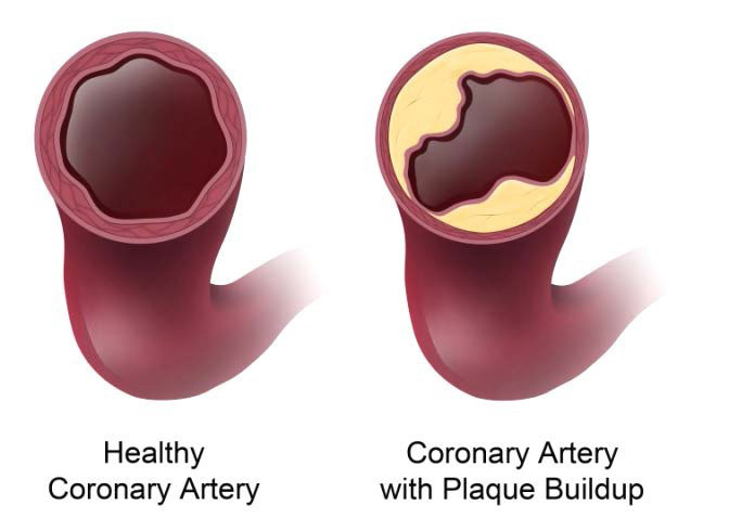 Side-by-side illustrations showing bisections of a healthy coronary artery and a coronary artery with plaque buildup.