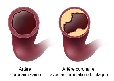 Saphène interne gauche