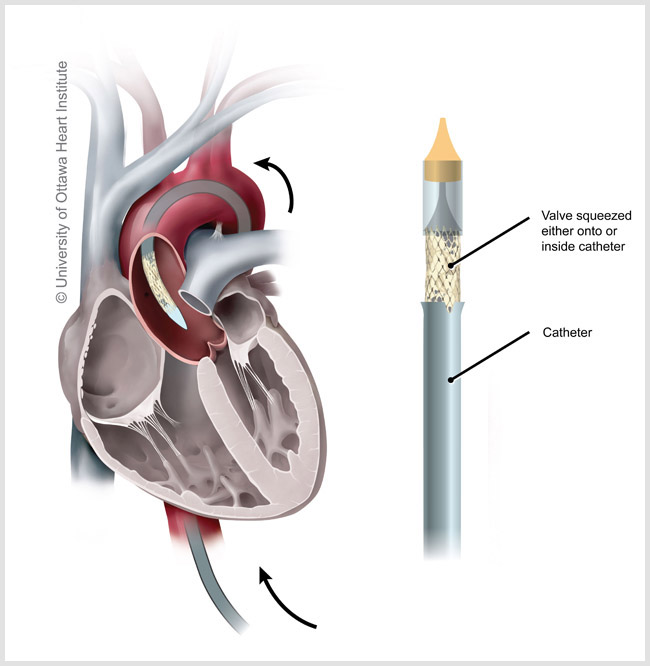 Illustration showing the catheter used during a TAVI procedure
