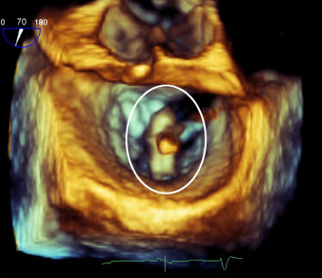 Dans cet échocardiogramme en 3D, le cathéter a été inséré du côté le plus éloigné de la valvule (zone en bleu, au centre) et la pince MitraClip (encerclée) a été fixée à la valvule fermée pour mieux sceller le tout et réduire le retour sanguin.