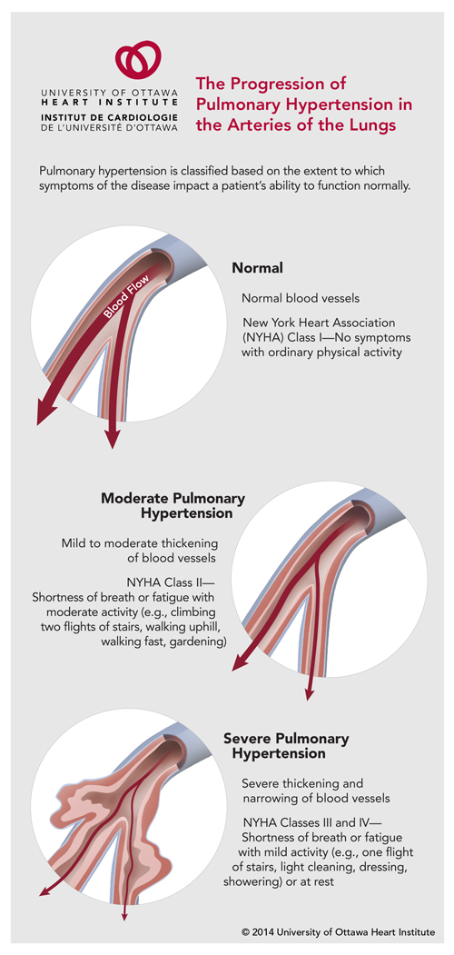 The Progression of Pulmonary Hypertension in the Arteries of the Lungs: Pulmonary hypertension is classified based on the extent to which symptoms of the disease impact a patient’s ability to function normally.  In normal blood vessels, blood flows as it should (New York Heart Association (NYHA) Class I — No symptoms with ordinary physical activity).  In moderate Pulmonary Hypertension, there is mild to moderate thickening of the blood vessels (NYHA Class II — Shortness of breath or fatigue with moderate activity (e.g., climbing two flights of stairs, walking uphill, walking fast, gardening)). In severe Pulmonary Hypertension, there is severe thickening and narrowing of blood vessels (NYHA Classes III and IV — Shortness of breath or fatigue with mild activity (e.g., one flight of stairs, light cleaning, dressing, showering) or at rest).