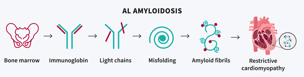 Illustration of amyloid light chain (AL). 