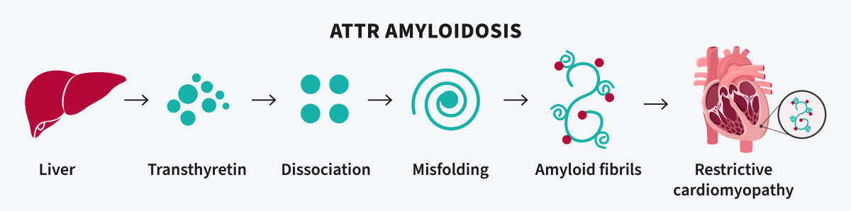 Illustration of transthyretin (TTR) amyloidosis.