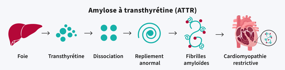 Amylose à transthyrétine (ATTR).