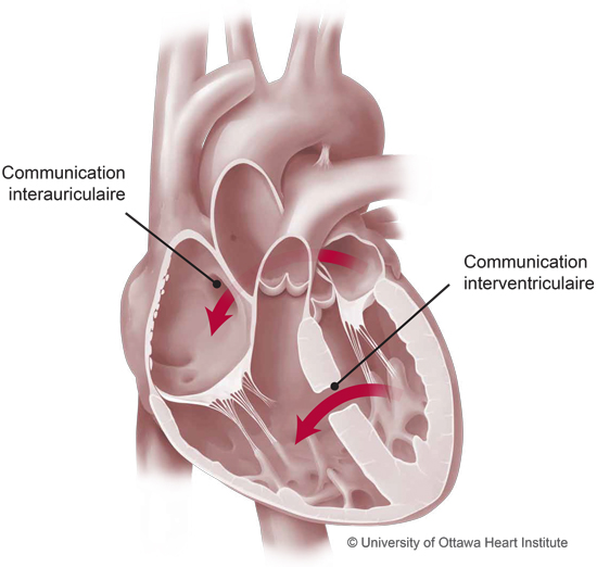 La cardiopathie congénitale de l'adulte