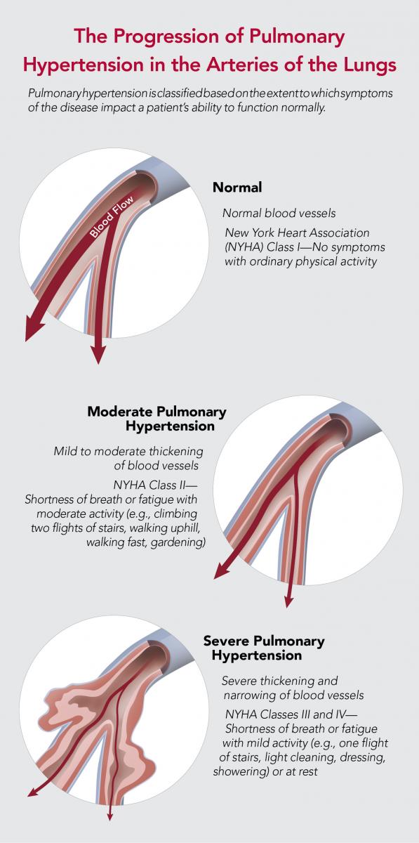 Progression of pulmonary hypertension in the arteries of the lungs