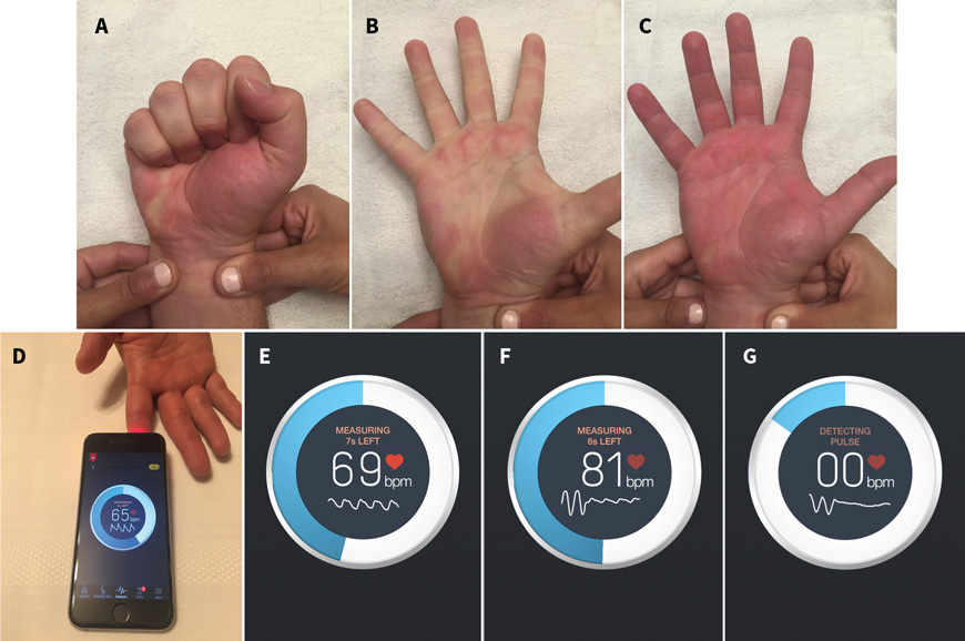 Demonstration of the modified Allen test and the smartphone-based heart rate-monitoring application. For a detailed description, read the study titled 'Photoplethysmography using a smartphone application for assessment of ulnar artery patency: a randomized clinical trial,' as published in the CMAJ. Image source: CMAJ.