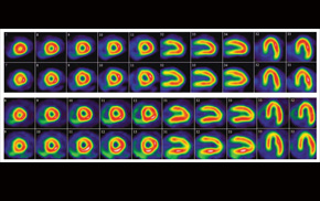 Myocardial perfusion imaging results of full and half-time scans showing how much blood reseaches different parts of the heart.