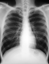 Radiographie thoracique montre la cage thoracique