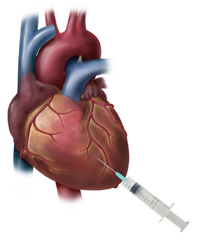 Image d’une aiguille qui injecte une thérapie cellulaire directement au cœur.