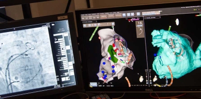 Fluoroscopy (left) provides an X-ray view of the heart and the position of the catheters. The mapping system (right) operates like a GPS system showing the location of the catheters in a three-dimensional view of the heart that can be rotated in any direction. Using this system reduces the need for fluoroscopy, cutting down on X-ray exposure for the patient.