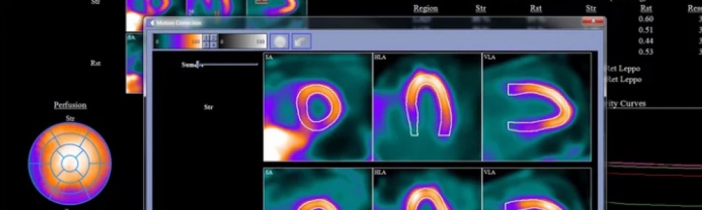 Myocardial Blood Flow with SPECT Imaging