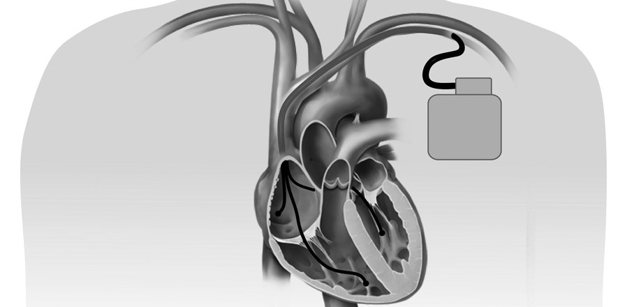 An illustration of an implantable cardioverter defibrillator (ICD)