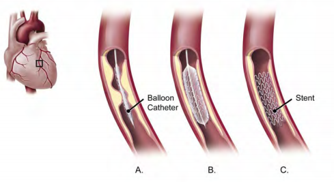 Medical illustration showing a balloon catheter inserted into an artery and inflated to place a stent, in order to widen a narrowed artery of the heart.