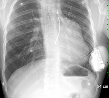 Cette radiographie des poumons 